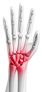 arthritis